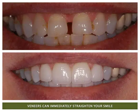 Before and after dental veneers