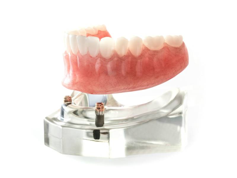 Implant dentures