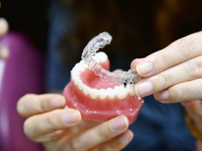 Model of clear aligners being placed on teeth