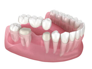 Dental Bridge