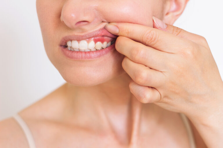 a close-up photo of a young Caucasian woman who shows off her red gums on the upper jaw, suffers from gum inflammation in Broomfield, CO.
