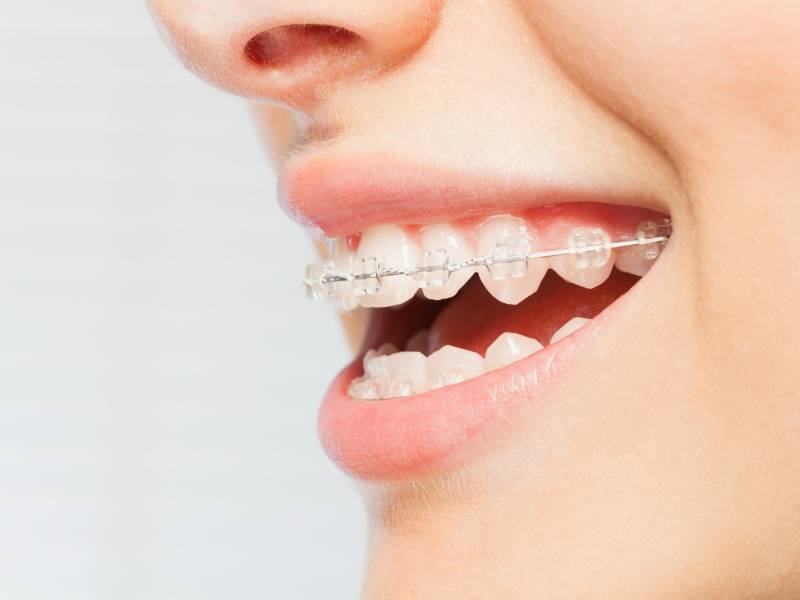 Invisible braces closeup of clear brackets on teeth in Broomfield, CO