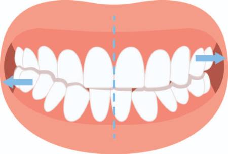 Crossbite graphic