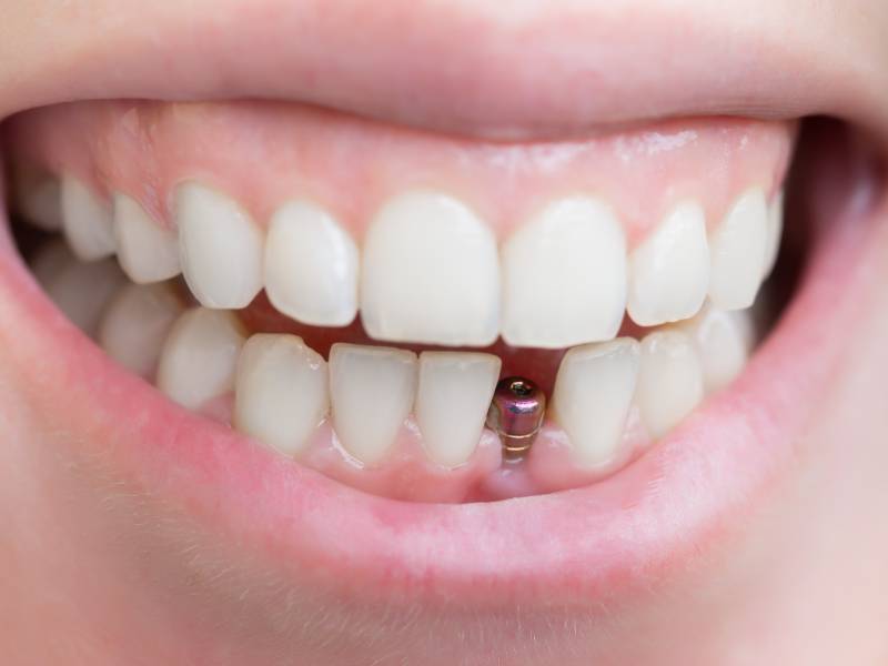 Implant abutment