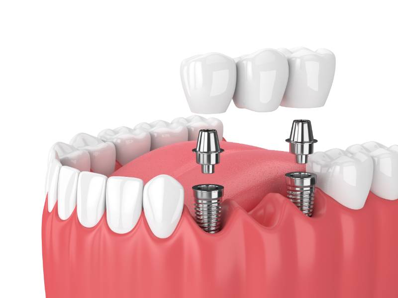 Implant bridge