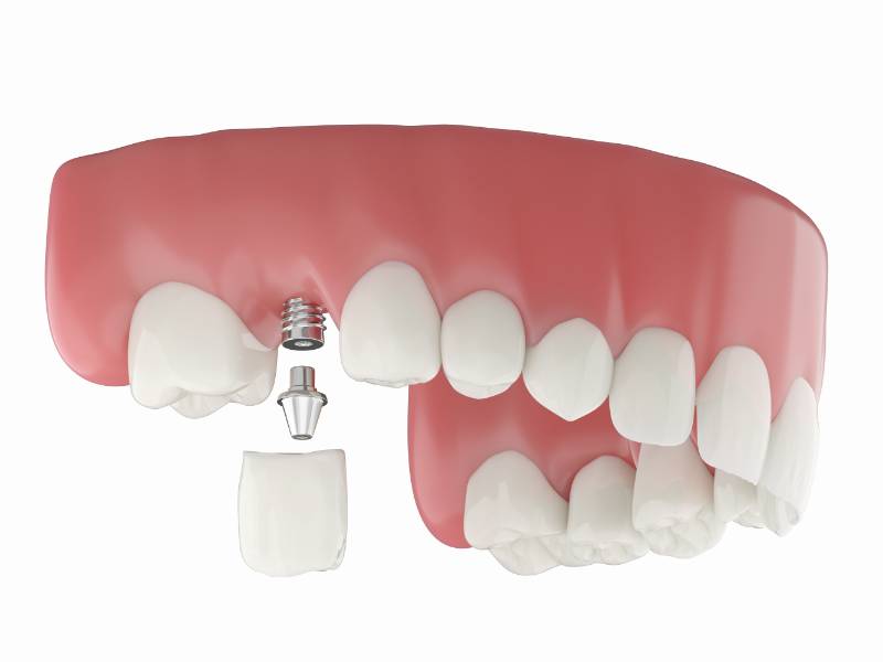Implant crown