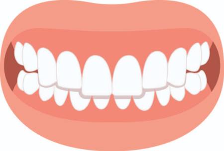Overbite graphic